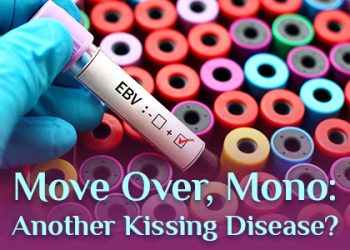 Bountiful dentist, Dr. Baird at Millcreek Family Dental talks about a kissing disease you might be less familiar with than mononucleosis.