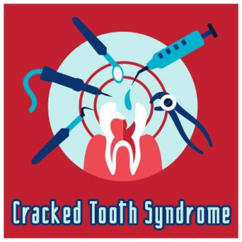 Bountiful dentist, Dr. Baird at Millcreek Family Dental, discusses causes, symptoms, and treatment of cracked tooth syndrome.